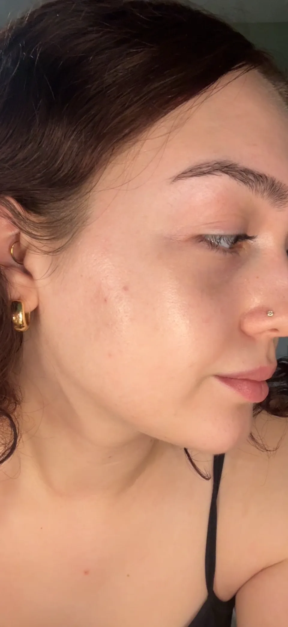 Emma's personal skin journey, left after photo