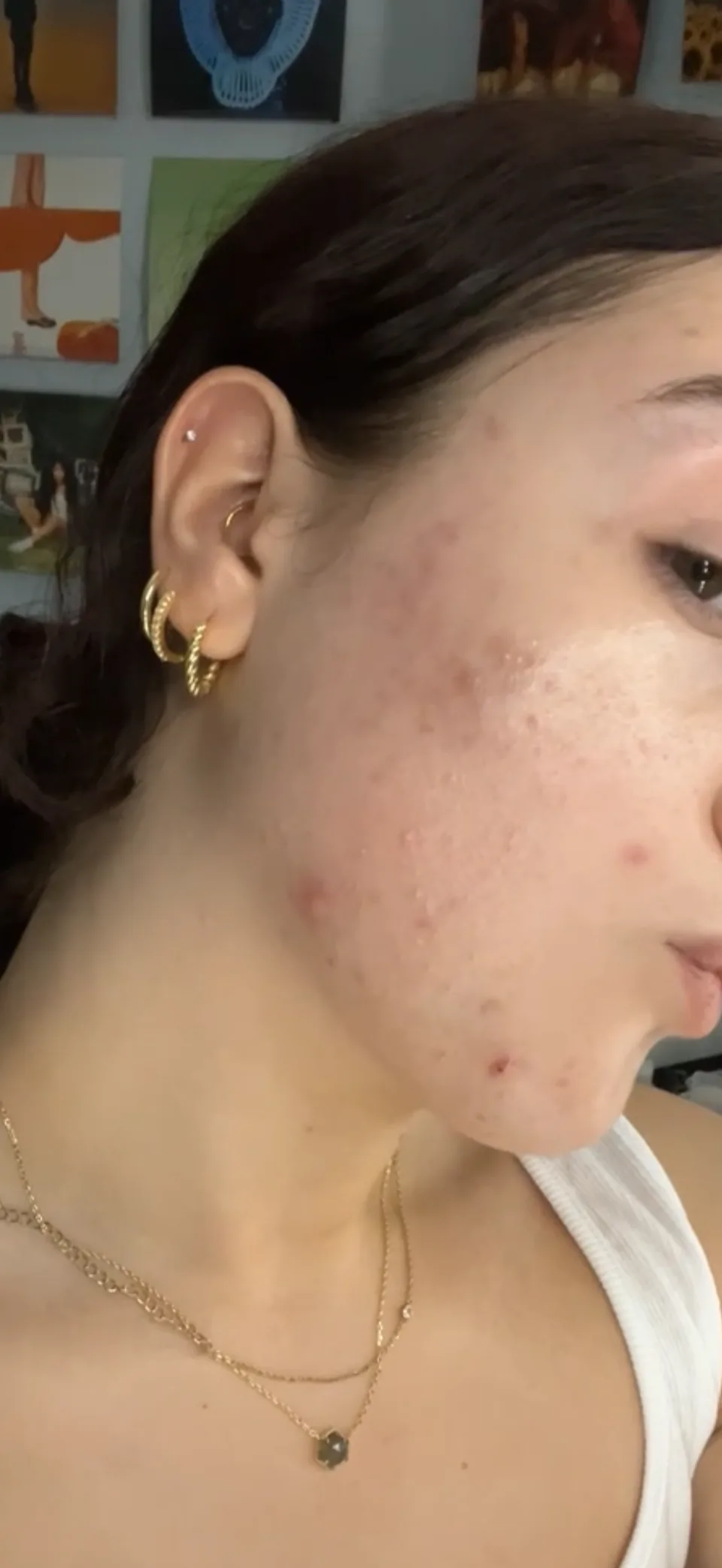 Emma's personal skin journey, left before photo