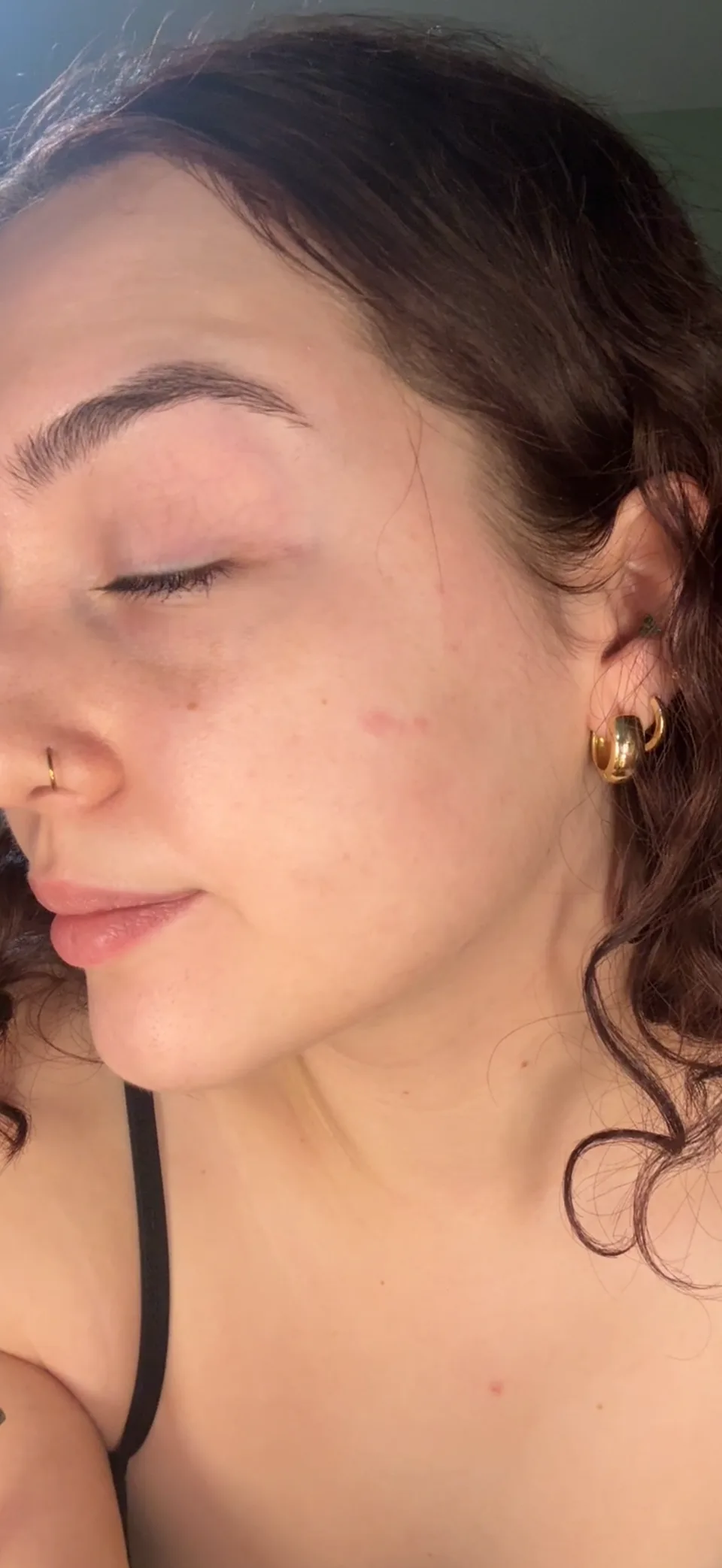 Emma's personal skin journey, right after photo