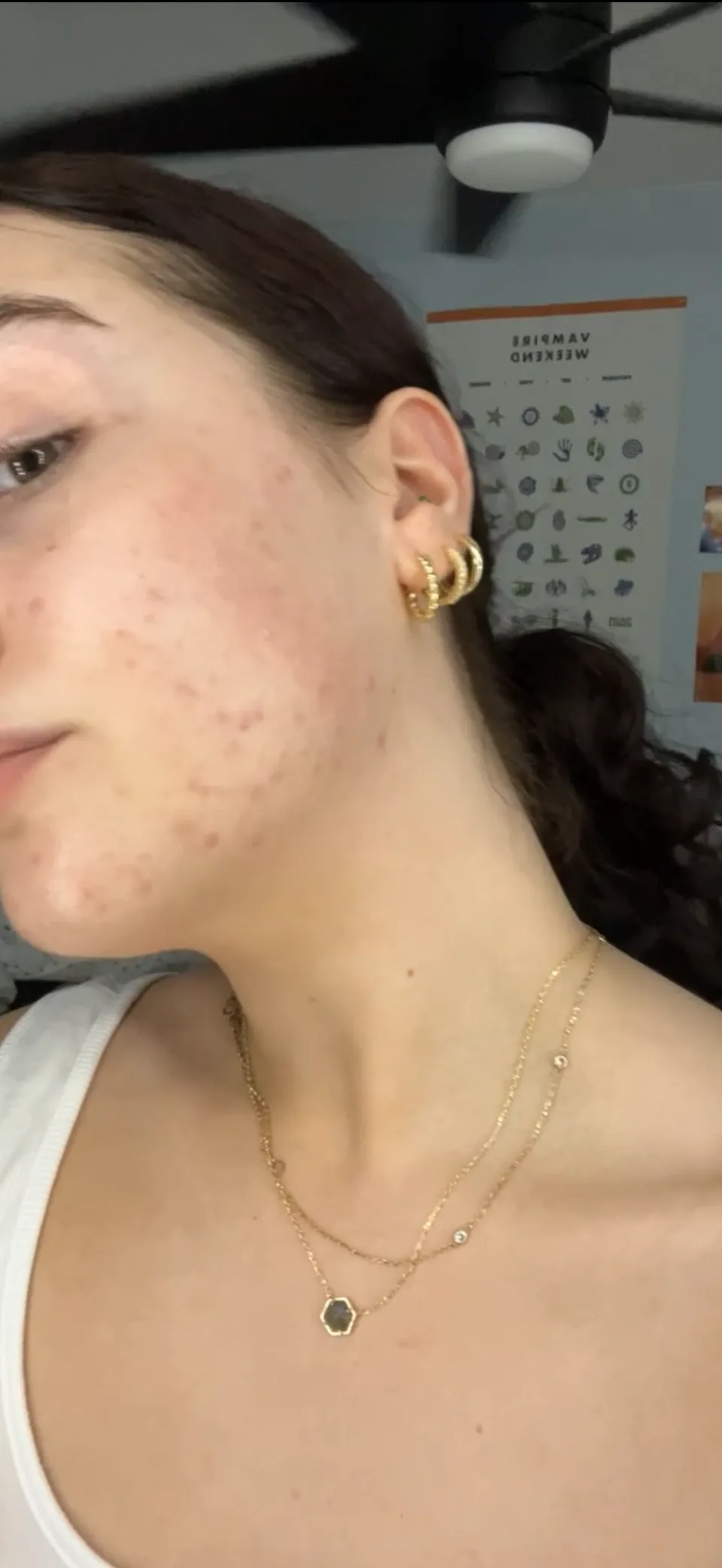 Emma's personal skin journey, right before photo